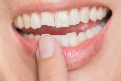 Chipped Tooth Example